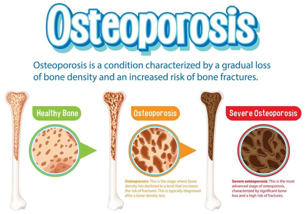 stages of osteoporosis